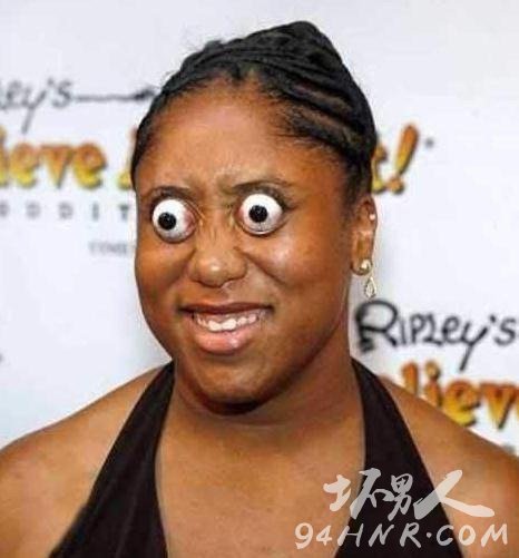 世界上眼球最突出的女人